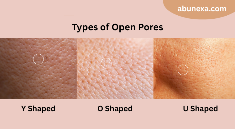 types of open pores on face